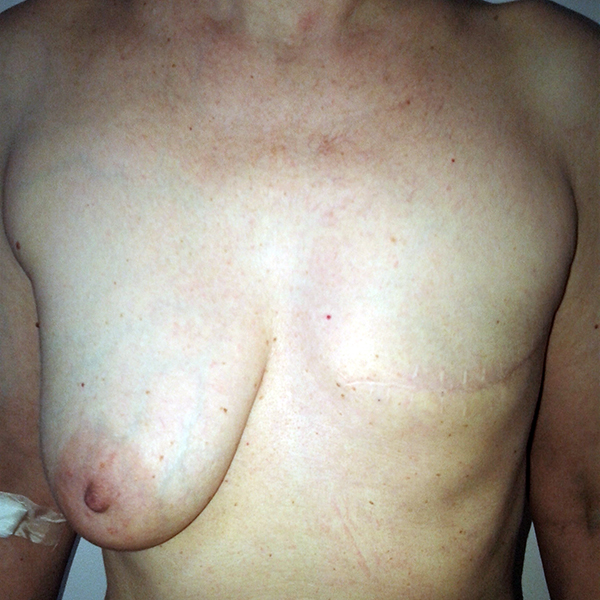 Before-Sekundarna rekonstrukcija dojke suspenzornom metodom