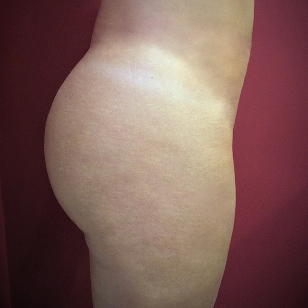 After-Gluteus
